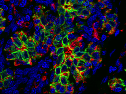 immunofluorescence image of a human breast cancer specimen