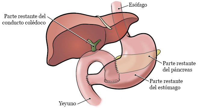Figura 2. El páncreas y los órganos circundantes después de la cirugía