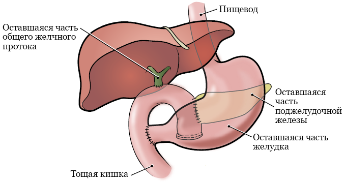 Рисунок 2.  Поджелудочная железа и окружающие органы после операции