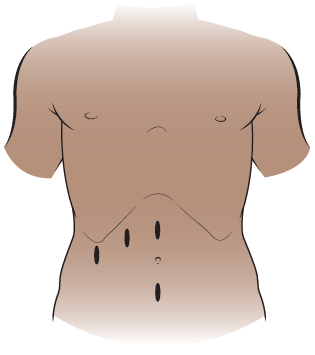Figure 2. Laparoscopic cholecystectomy incisions
