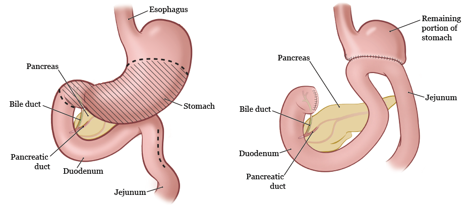 图 2 和图 3. 胃次全切除术前（左）和术后（右）的消化系统