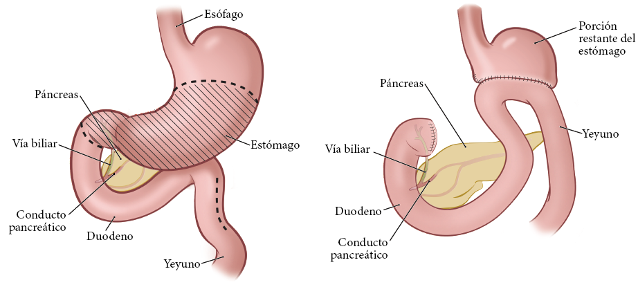 Figuras 2 y 3. Su sistema digestivo antes (izquierda) y después (derecha) de su gastrectomía parcial (izquierda)