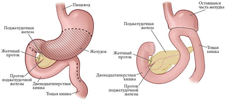 Рисунки 2 и 3. Пищеварительная система до (слева) и после (справа) субтотальной гастрэктомии
