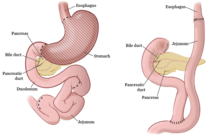 图 4 和图 5. 胃全切除术前（左）和术后（右）的消化系统