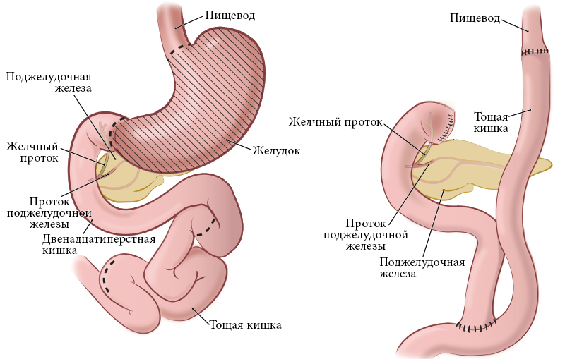 Рисунки 4 и 5. Пищеварительная система до (слева) и после (справа) тотальной гастрэктомии