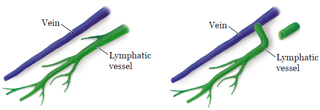 Figure 1. Joining a damaged lymphatic vessel to a vein