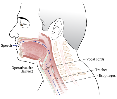 Figure 1. Before laryngectomy