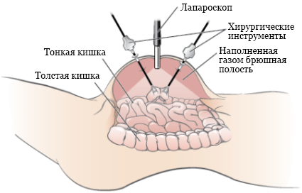 Рисунок 1.  Брюшная полость во время диагностической лапароскопии