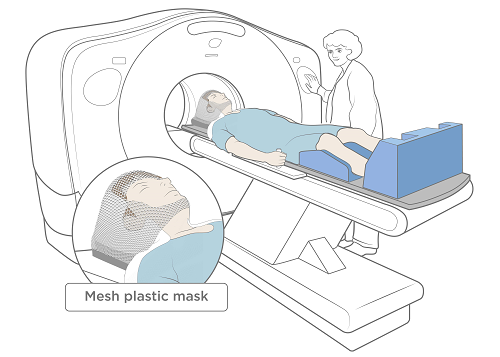 Hình 3. Chụp cắt lớp vi tính (CT) với mặt nạ lưới trên khuôn mặt hở