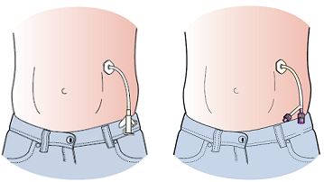 Figure 3. Legacy gastrostomy tube (left) and ENFit (right)