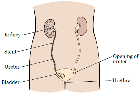 图 1. 输尿管支架