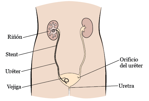 Figura 1. Stent ureteral