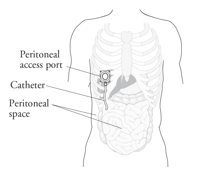 kidney dialysis long time outcomes home dialysis patient schooling
