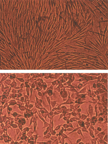 Melanoma cells expressing dipeptidyl peptidase IV (top), and the same cell line without DPPIV (bottom)