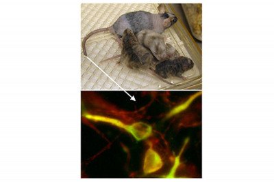 Autologous dopamine neurons