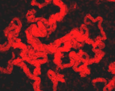 Virulent M. tuberculosis stained with Auramine Rhodamine.
