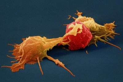 Pictured: Natural Killer Cells &amp; Cancer Cell