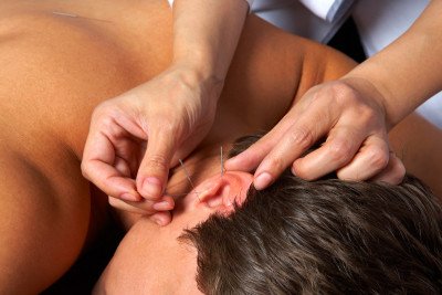 Acupuncture needles are inserted into specific locations (acupoints) on the body.