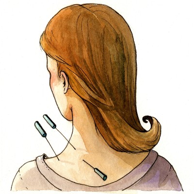 Acupuncture