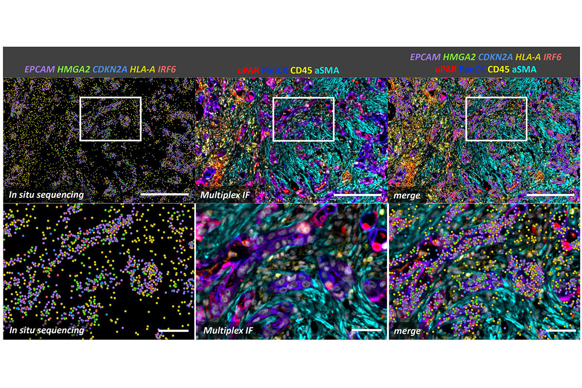 Figure 2. Spatial analysis of senescence at the single-cell level of pancreatic cancer treated with a senescence-inducing chemotherapy. In situ sequencing on the Xenium platform was followed by multiplex immunofluorescence using the CellDive instrument. Senescent cells, characterized by the expression of HMGA2, CDKN2A, and uPAR markers, are enriched among tumor cells (PanCK+ cells). Senescent tumor cells show activation of interferon signaling (IRF6) alongside the expression of MHC I markers (HLA-A), which enhances their susceptibility to immune system recognition. Scale bars: 250 µm in top row and 50 µm in bottom row. 
