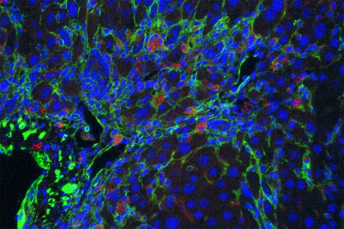 Figure 3. Senolytic CAR T cells. CAR T cells specific for uPAR (red) target senescent cells (green) in a mouse model of liver fibrosis.