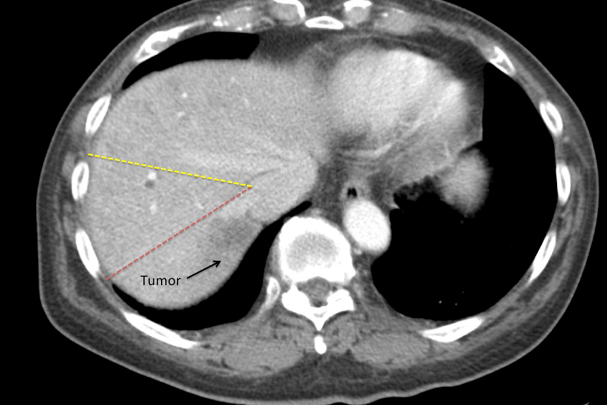Tumor in posterior section of liver, CT scan