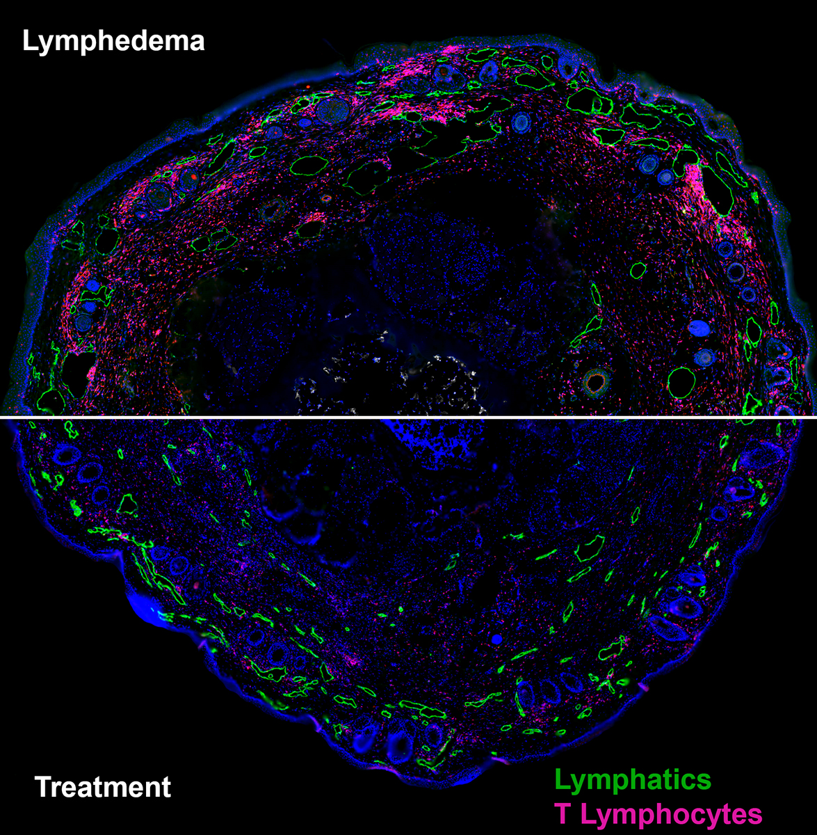 Th2 type T cells in lymphedema pathology