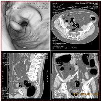 View of a cancerous colon using a virtual colonoscopy, and three views of the same colon using a CT scan.