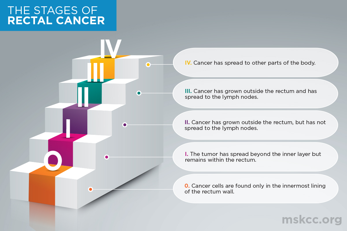 Stages of Rectal Cancer Infographic