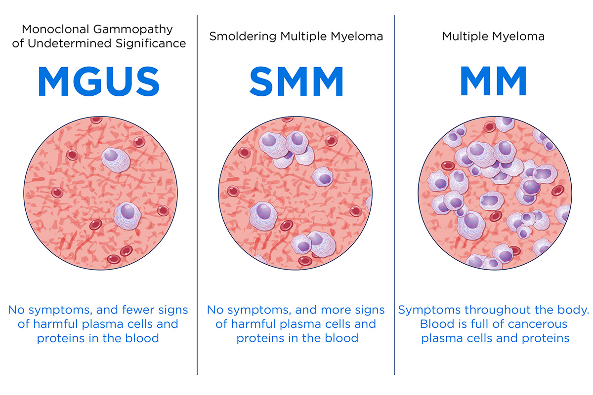 This chart explains symptoms of MM, MGUS, and SMM