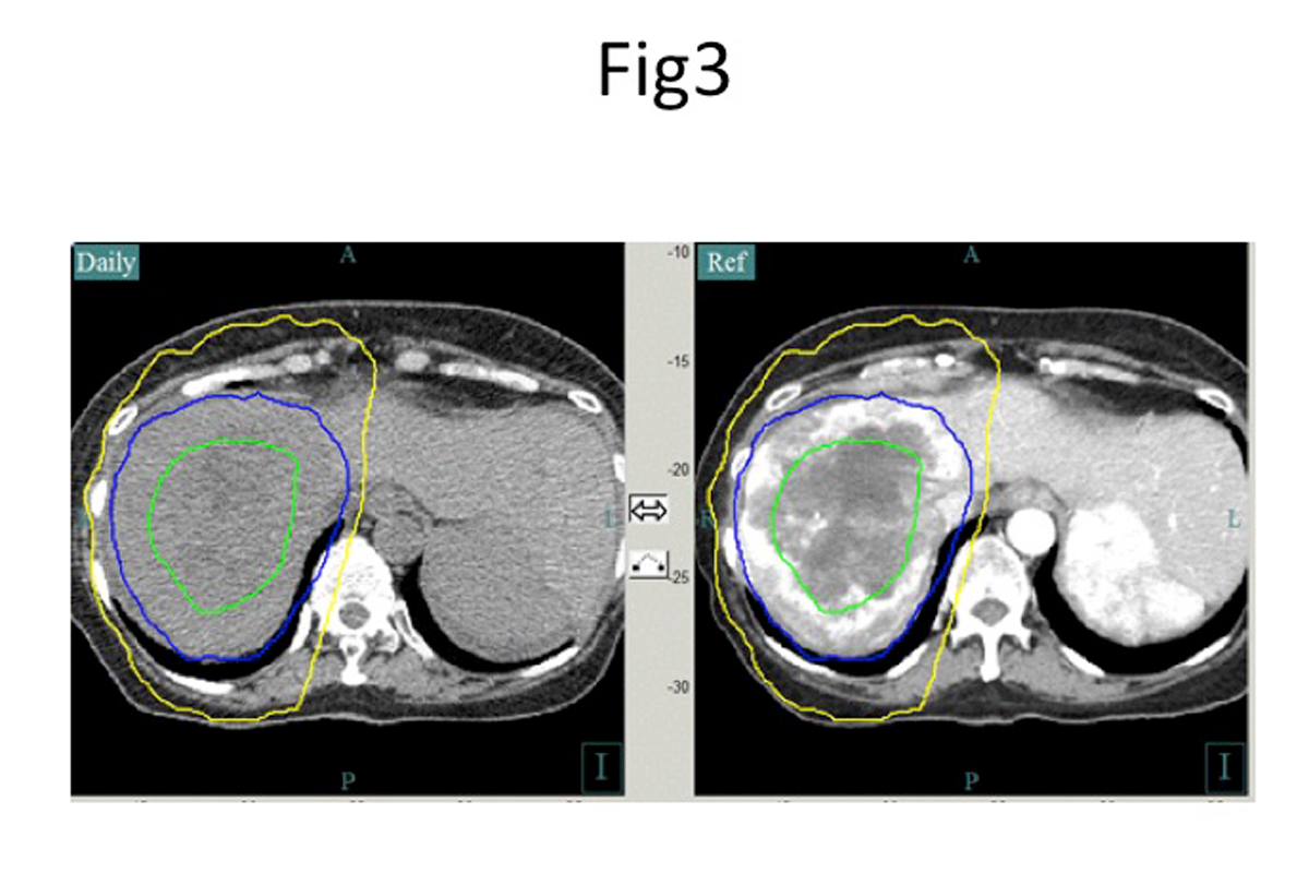 Results of Stereotactic Ablative Radiotherapy (SABR) for Liver Primary Tumors