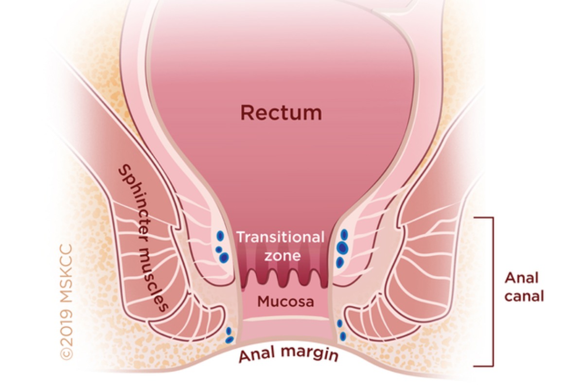 benign papillary mesothelioma peritoneal