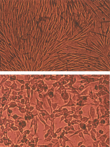 Melanoma cells expressing dipeptidyl peptidase IV (top), and the same cell line without DPPIV (bottom)