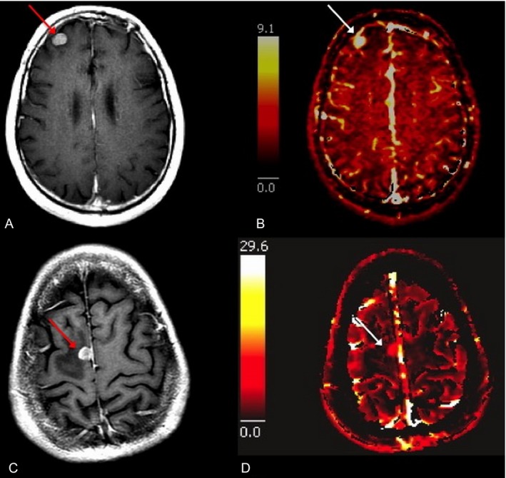Conventional MRI & dynamic contrast-enhanced MRI models