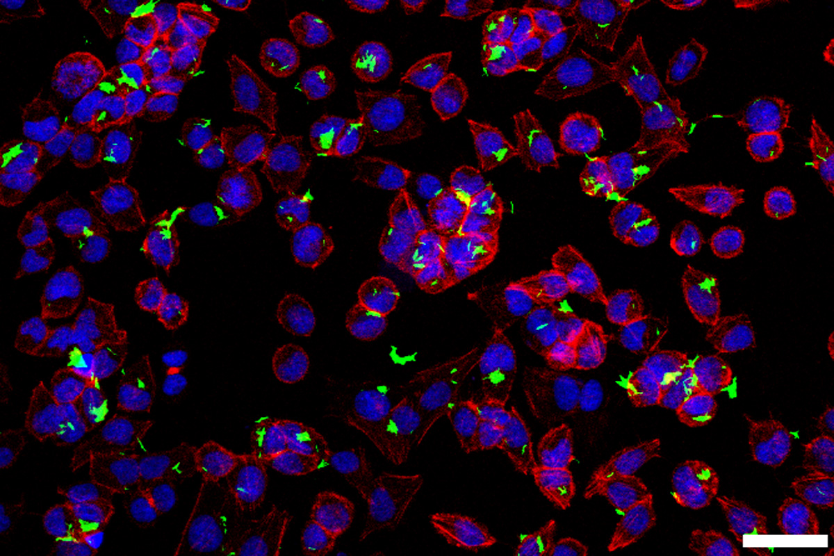 BCG infection of bladder cancer cells -- Shown is a fluorescent image of BCG expressing green fluorescent protein infecting the bladder cancer cell line UMUC3