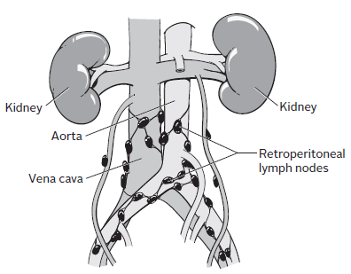 About Your Retroperitoneal Lymph Node Dissection | Memorial Sloan