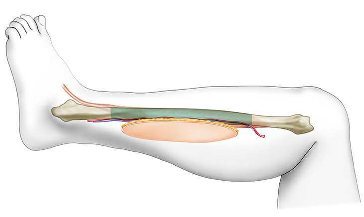 About Your Mandibulectomy And Fibula Free Flap Reconstruction