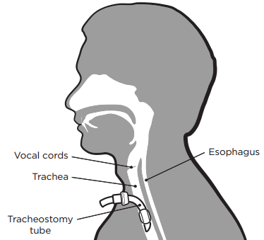 trach1.png
