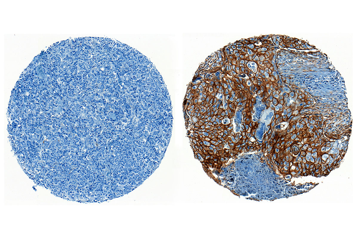 Examples of human triple negative breast cancer staining negative (left) and positive (right) for ENPP1 expression.