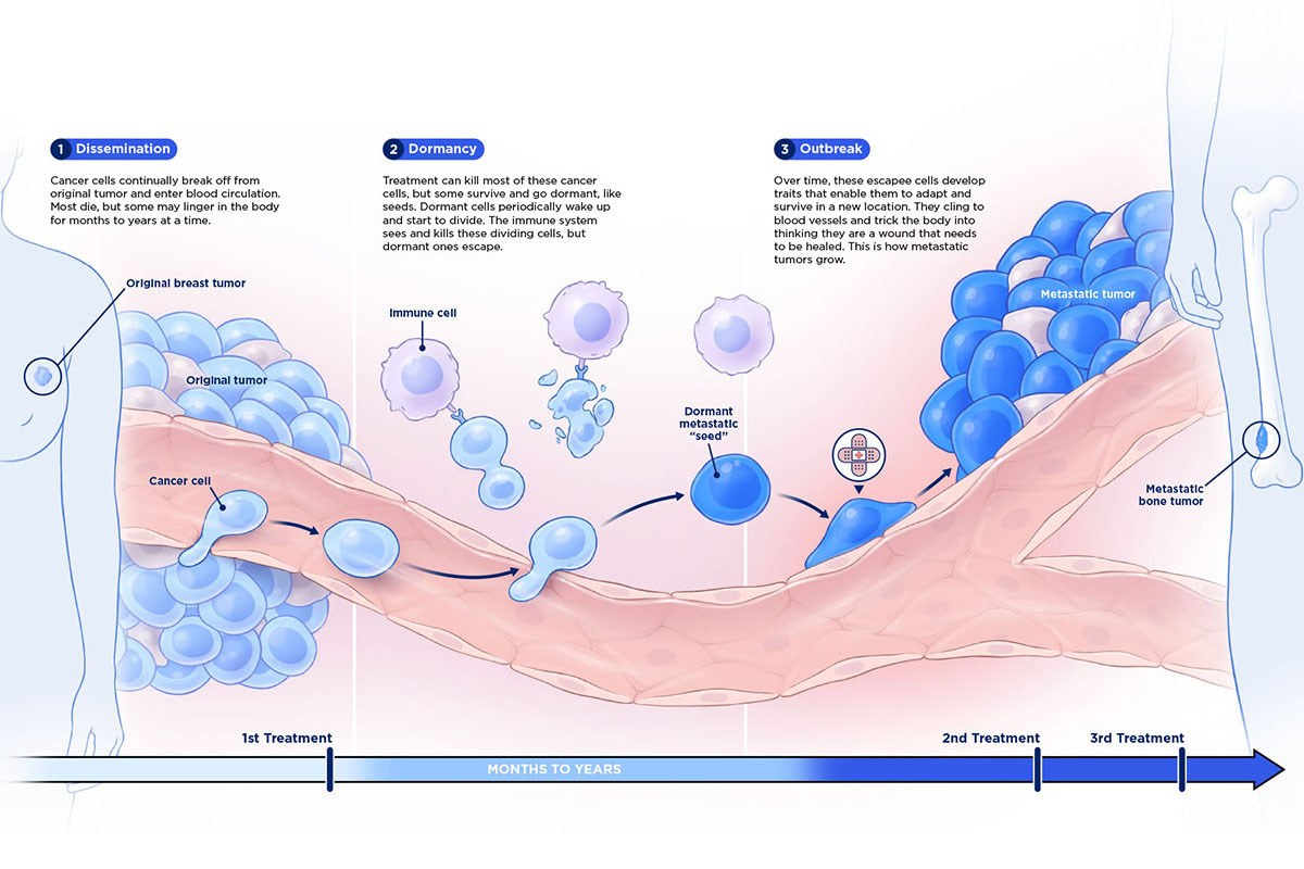 Illustration explaining the stages of cancer metastasis
