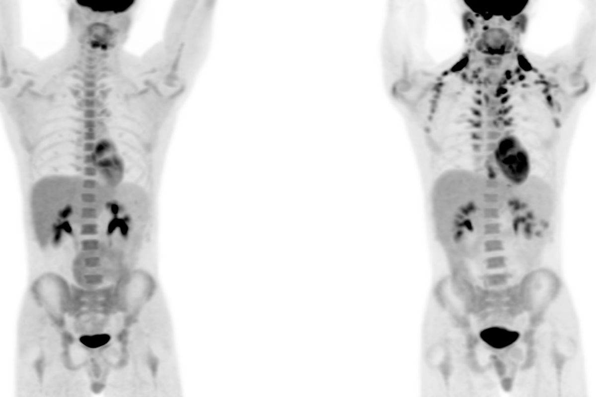 side-by-side PET scan showing presence and absence of brown fat