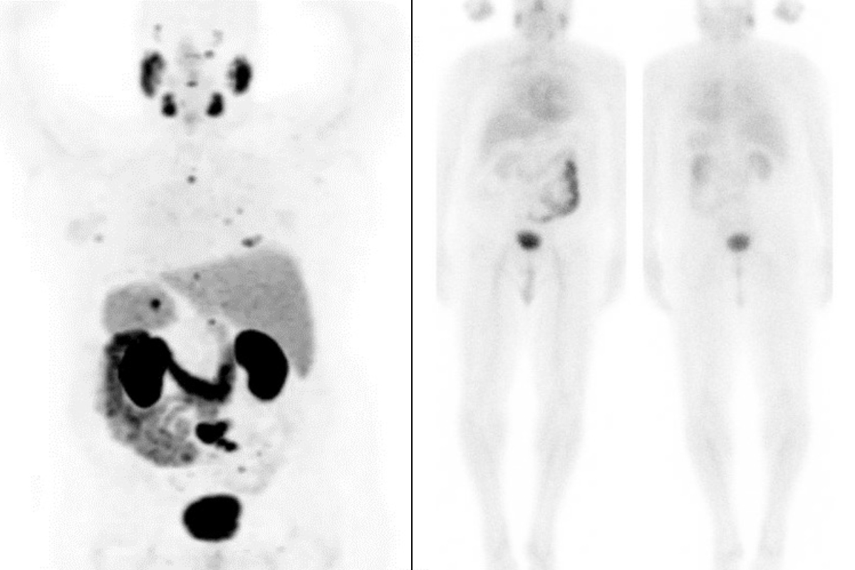 PET scans of patient with metastatic cancer before and after treatment.