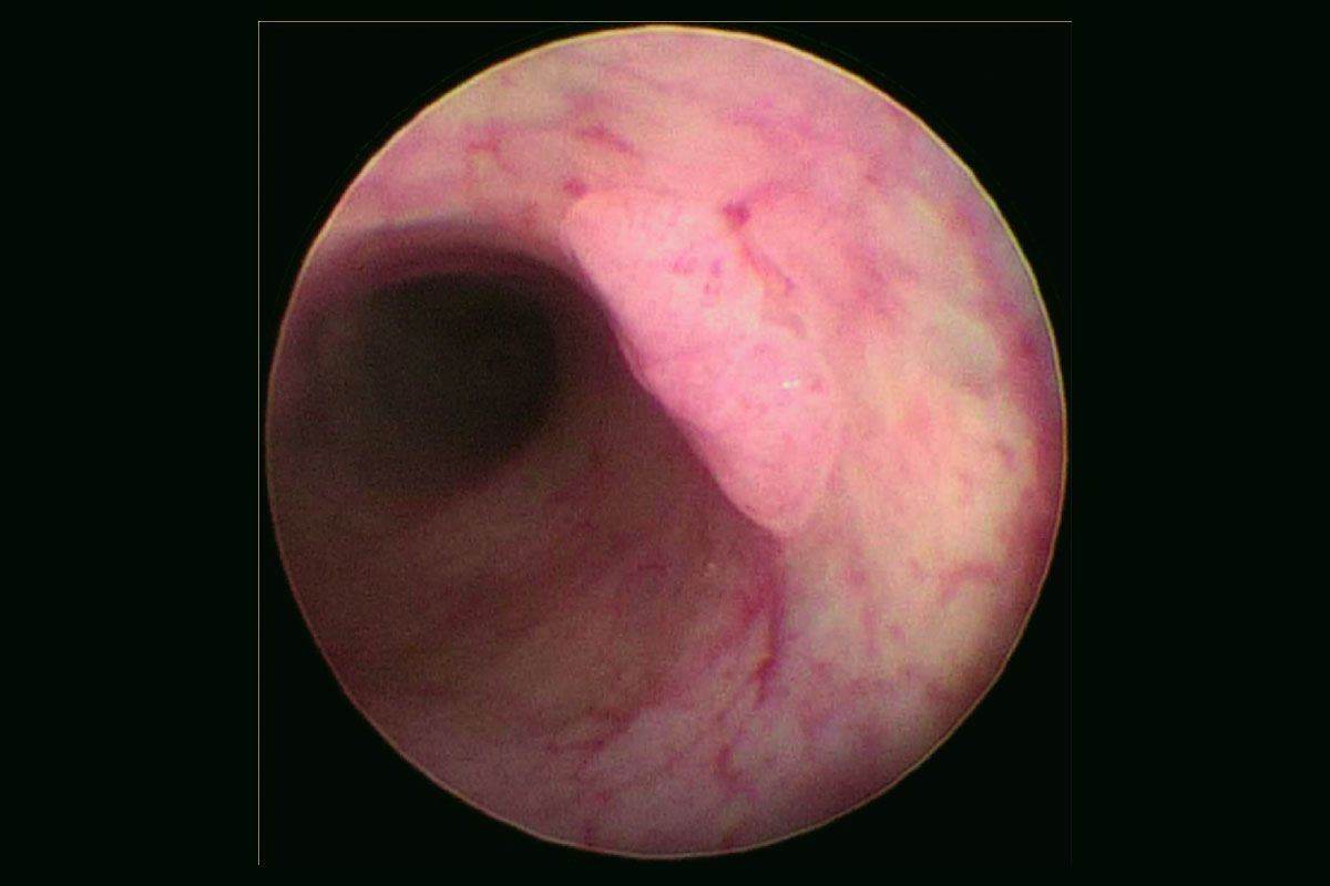The endoscopic view of the patient-derived tumoroids implanted in the NOD-SCID (NSG) mouse distal rectum.