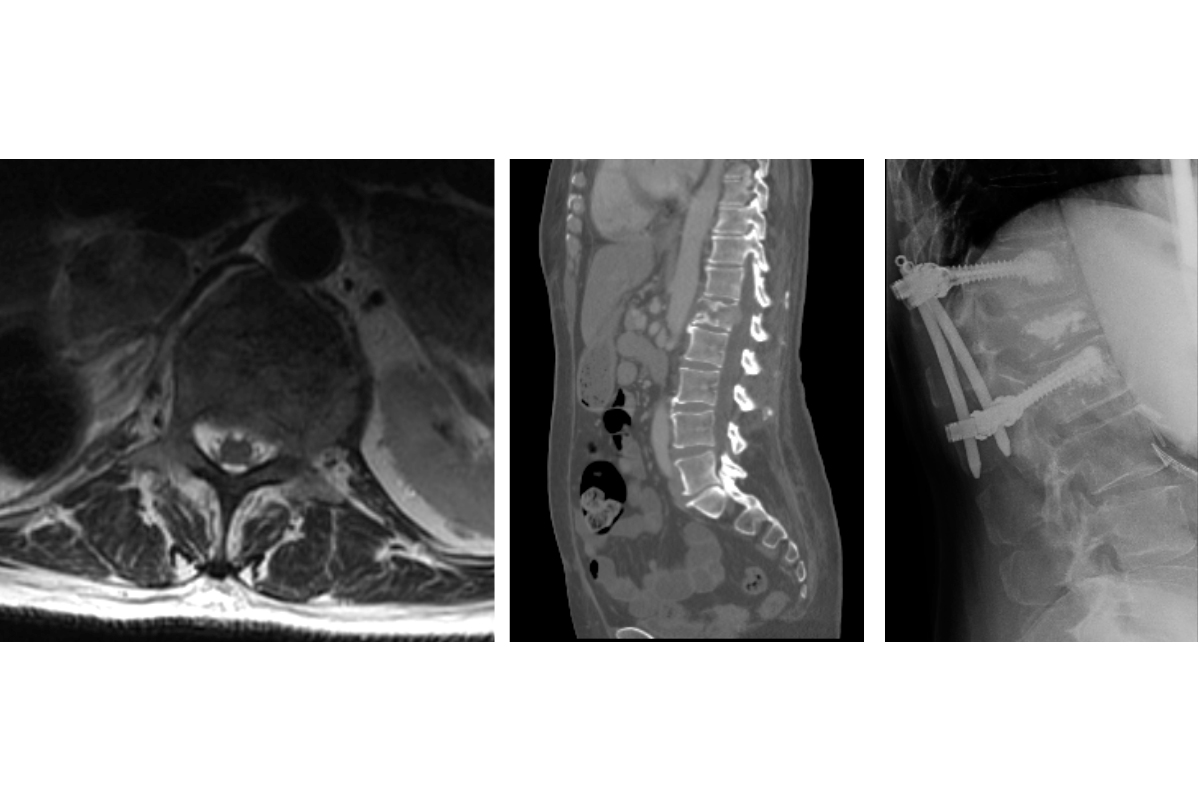 Figure 1.  A 51-year old woman with metastatic renal cancer presented with severe mechanical back pain resulting from an L1 burst fracture involving bilateral pedicles and moderate epidural extension. She underwent an L1 kyphoplasty with T12-L2 cement augmented percutaneous instrumented stabilization. By post-operative day two she reported complete resolution of the mechanical pain, returned to unassisted ambulation and underwent simulation for IGRT.
