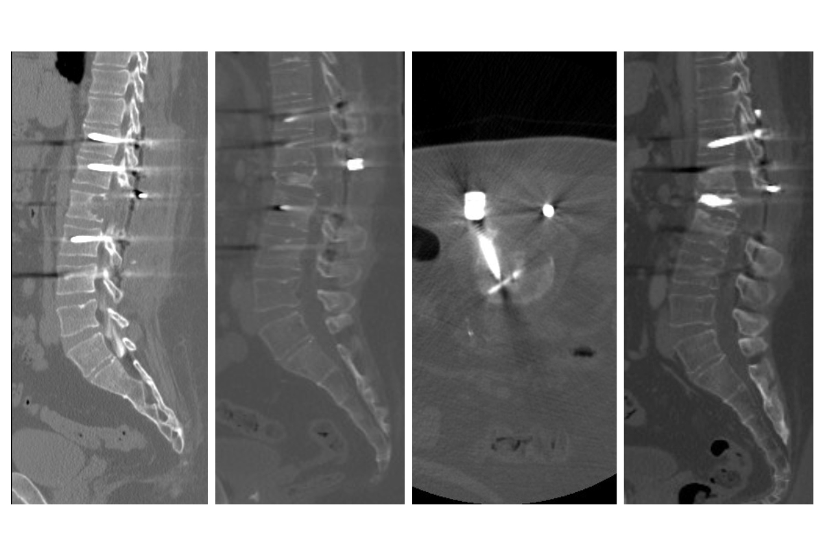 Figure 2. Renal cancer with L1 metastasis treated with surgical decompression followed by SRS. A reconstructed sagittal CT of the lumbar spine obtained post L1 laminectomy and stabilization revealing a lytic metastasis, but no collapse. B, follow-up CT scan 23 month later showing a moderate L1 collapse. C, Intraprocedural CT confirms an adequate trajectory through the L1 vertebral body. D, Post augmentation CT scan showing good filling of the L1 vertebral body.