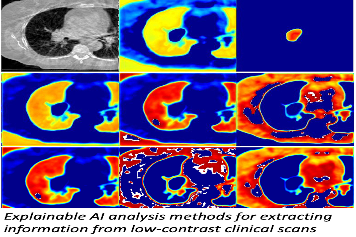 Our AI models identify features that best signal contrast between tumor and background for highly accurate tumor segmentation.
