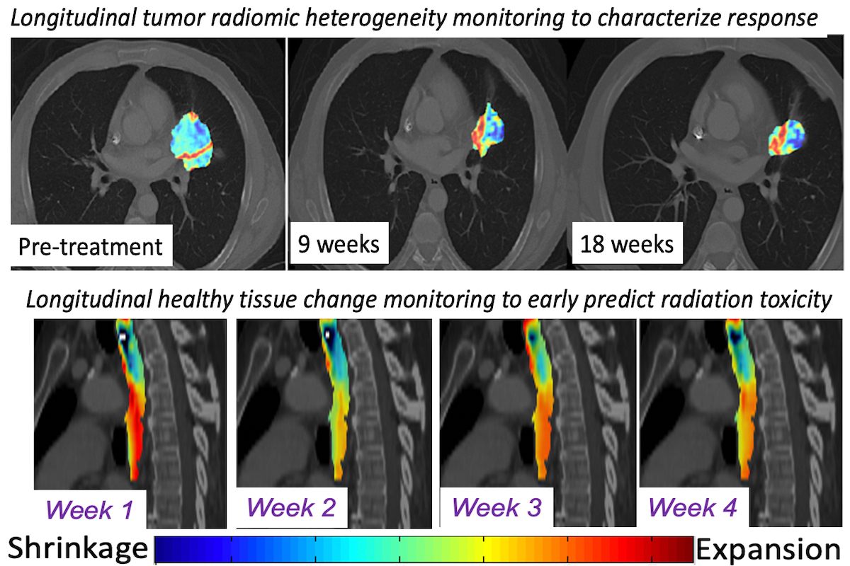 Our AI models can track voxel-level changes in tumors and organs to provide explainable biomarkers of treatment outcomes.