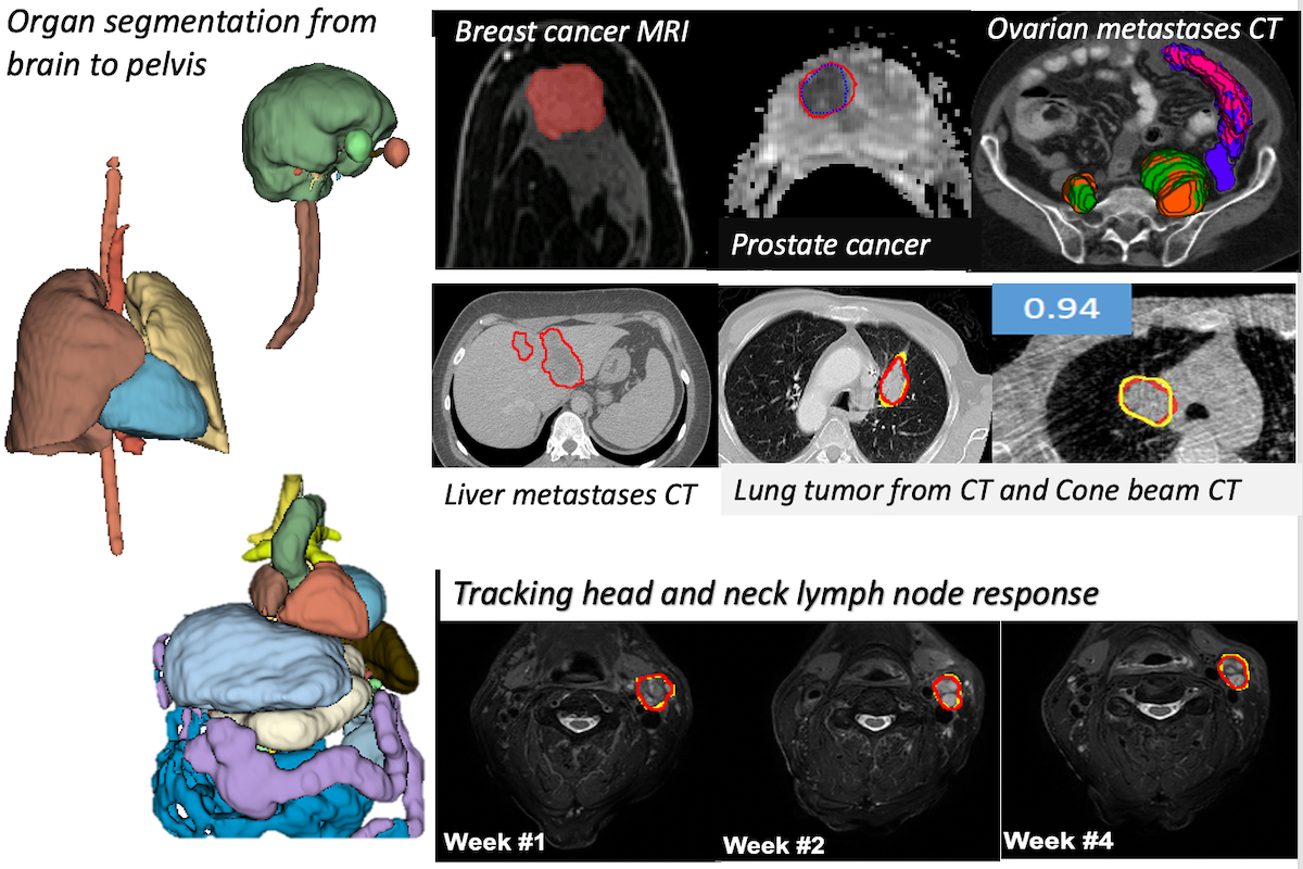 Our AI image foundation models segment organs from brain to pelvis and are capable of segmenting tumors from multiple imaging modalities.