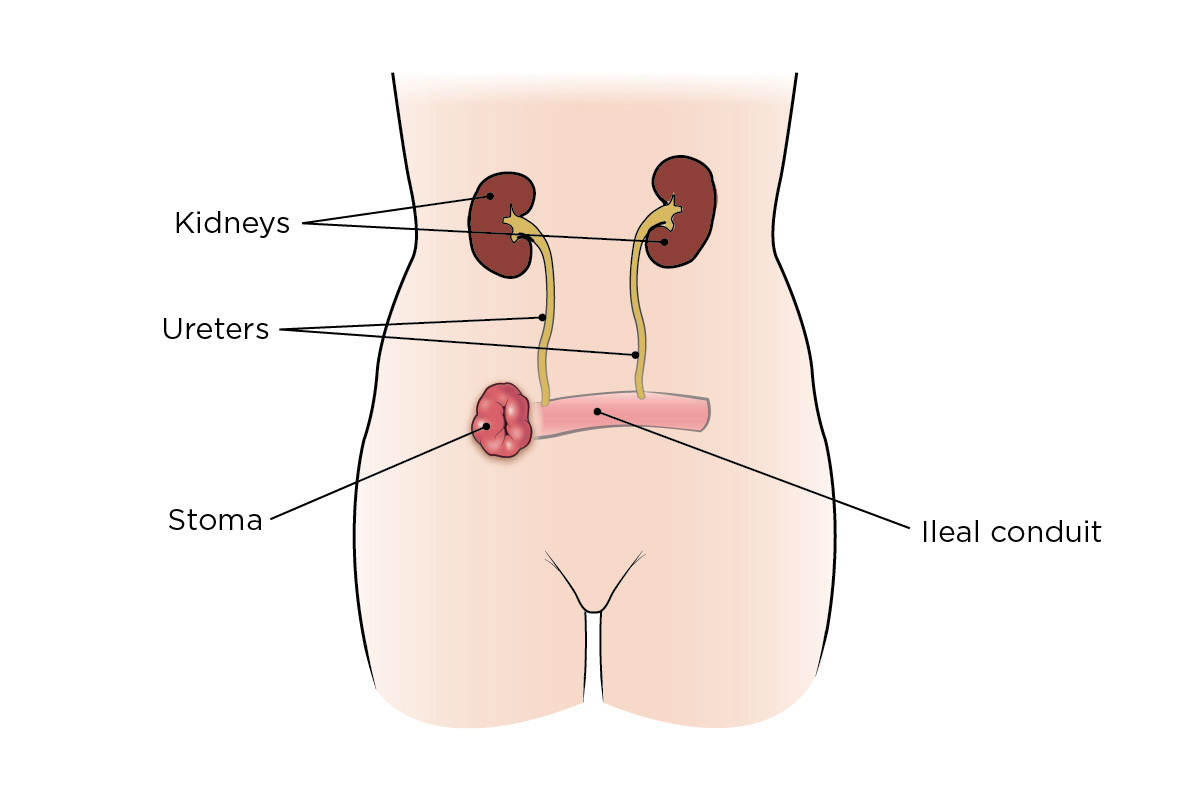 Your urinary system after your bladder surgery with a urostomy (ileal conduit)