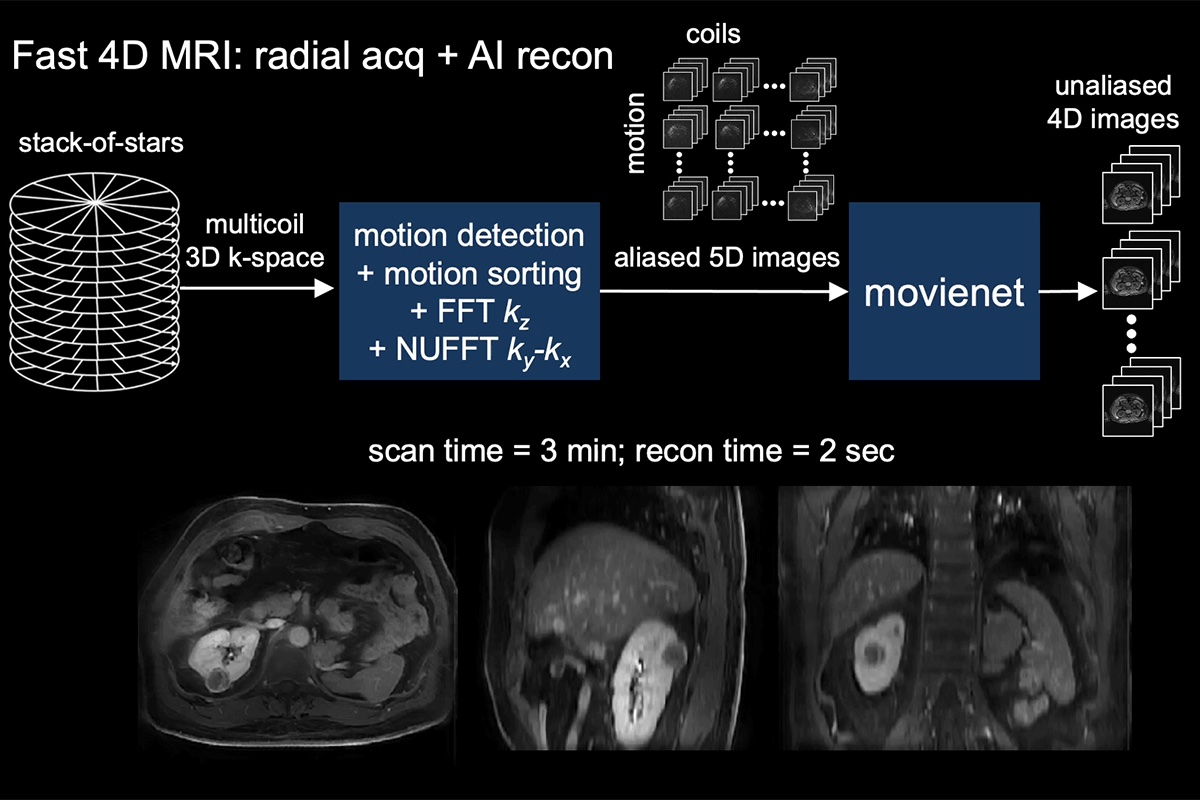 Figure 2: Fast 4D MRI using auto-navigated radial acquisition and AI reconstruction (movienet). In addition to reducing scan time compared to compressed sensing, movienet enabled reconstruction times of only 2 seconds